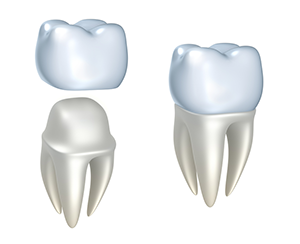 Dental Crowns | Dentist in New Port Richey, FL | Trinity Dental Designs