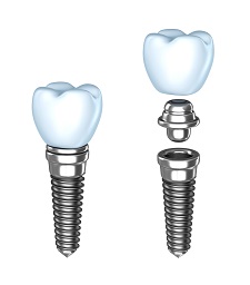 Dental Implants | Dentist in New Port Richey, FL | Trinity Dental Designs